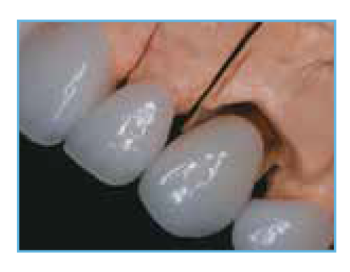 Final Crowns on the Master Cast An image of the final crowns for both the natural teeth and the implant, as they appear on the master cast before being cemented in the patient's mouth.