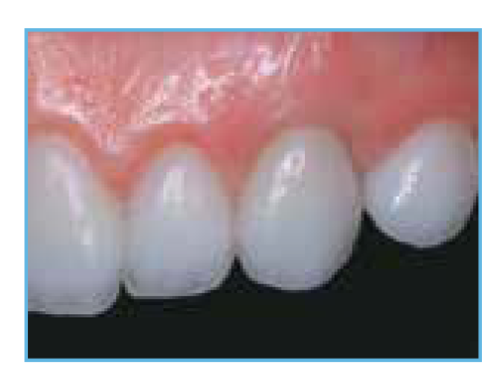 Final Aesthetic Clinical Outcome The final clinical photo showing the completed case, highlighting the excellent aesthetic value of both the natural tooth restorations and the implant-supported restoration.