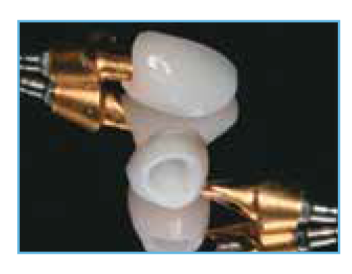 IPS e.max Crowns and Gold-Colored Abutment A close-up view of the IPS e.max glass-ceramic crowns and the BellaTek Gold-Colored Nitride Coated Abutment that were custom-fabricated for the case.