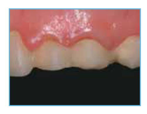 A 35-Year-Old Patient's Provisional Restoration An initial clinical photo showing a 35-year-old female patient with a provisional restoration on teeth numbers 11-14 that she found unsatisfactory.