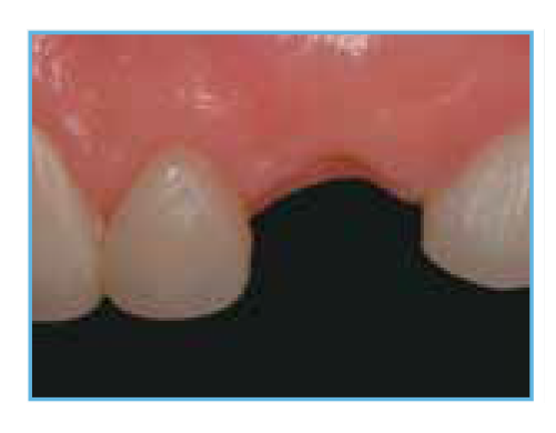 Post-Orthodontic and Post-Provisional Restoration A clinical image of the patient's mouth after orthodontic treatment and the removal of the provisional restoration, showing the current state of the teeth and gums.