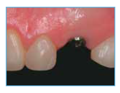 Placement of Full Osseotite and Encoded Healing Abutment This figure shows a ZimVie Full Osseotite Tapered implant and a BellaTek Encoded Healing Abutment that have been placed to prepare for the final restoration.